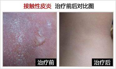 大家都在问:接触性皮炎有哪些症状?