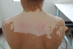 白斑怎么治才能一去不复返?