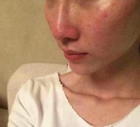 痘痘挤过留下丑陋的痘印、痘疤怎么办?