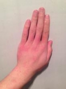 荨麻疹的症状以及分类有哪些?