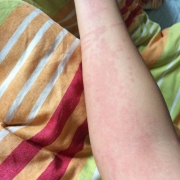 急性荨麻疹治疗方法