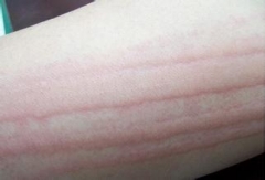 治疗慢性荨麻疹方法