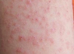 寒冷性荨麻疹怎么得的 怎么治疗 