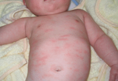 小儿荨麻疹原因 小儿荨麻疹症状表现 