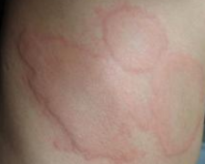 过敏性荨麻疹原因 过敏性荨麻疹症状