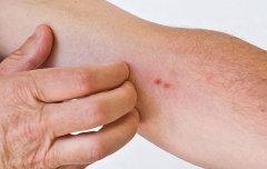 预防冬季皮肤瘙痒需要怎么做 