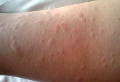 秋季荨麻疹会传染吗 有哪些症状 