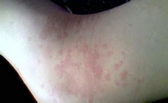 慢性荨麻疹会传染吗 有哪些危害