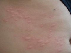 小儿荨麻疹的症状有哪些 