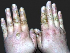 如何分辨手部湿疹和手癣 