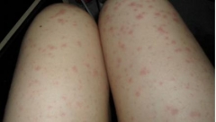 治疗丘疹性荨麻疹的方法