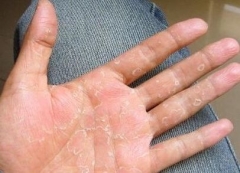 如何区分手部湿疹和手癣 