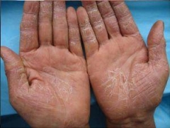 出现手部湿疹的原因有哪些 