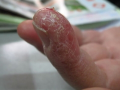 药物性皮炎的分类和症状表现