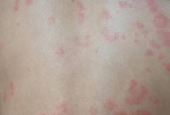 引起寒冷性荨麻疹的原因 