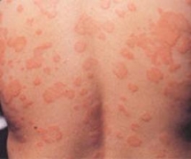 秋季荨麻疹有哪些原因 怎么预防 