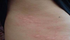 过敏性荨麻疹的分类及症状