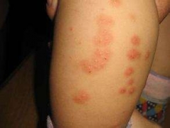 得了丘疹性荨麻疹有哪些症状表现 