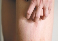 预防冬季皮肤瘙痒 日常护理来帮忙 