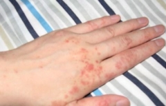 冬季出现手部湿疹怎么护理 