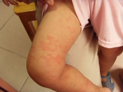 治小儿荨麻疹 从生活细节做起