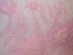 诱发寒冷性荨麻疹的四大因素 