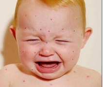 春季到来 如何预防小儿荨麻疹 