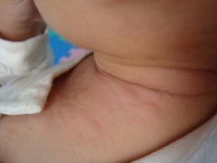 预防小儿荨麻疹 从生活细节做起 