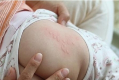 小儿荨麻疹的生活原因有哪些 