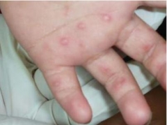 治秋季荨麻疹需做好家庭护理 