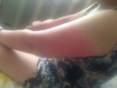 预防日光性皮炎的四点