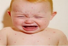 小儿荨麻疹的饮食注意 