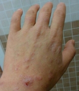 引发手部湿疹的原因有哪些 