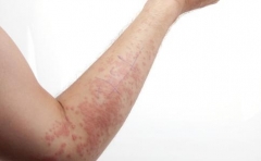 胆碱能性荨麻疹患者怎么护理 