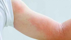 关于急性荨麻疹的简单介绍 