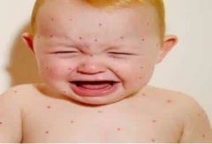 小儿荨麻疹常见的原因有哪些 