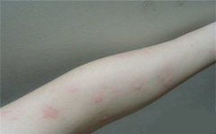 预防人工荨麻疹的细节 