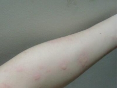 秋季荨麻疹的防治攻略