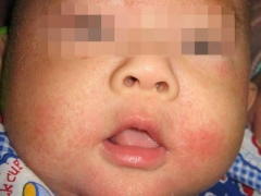宝宝出现皮炎湿疹的四大因素 