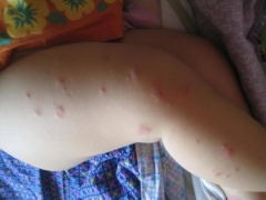 丘疹性荨麻疹的原因和症状特征 