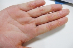 手部湿疹是哪些因素引起的 
