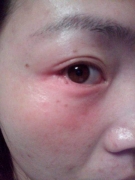 面部皮肤过敏如何护理