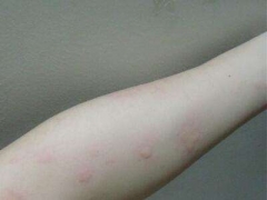 秋季荨麻疹的危害 