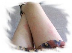 慢性荨麻疹的症状特征 
