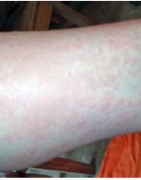 寒冷性荨麻疹的症状表现 