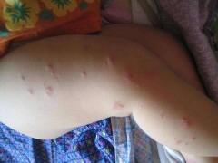 儿童荨麻疹护理禁忌 