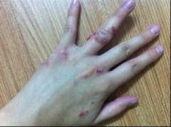 引发手部湿疹的因素 