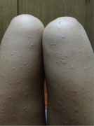 不同类型荨麻疹的症状