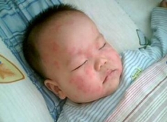 丘疹性荨麻疹如何科学护理 