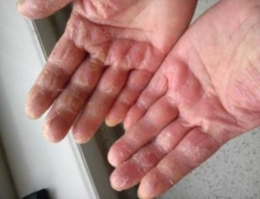 冬季出现手部湿疹的原因 